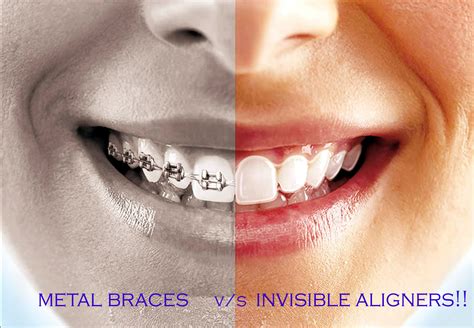 clear brackets vs metal|clear aligners vs braces.